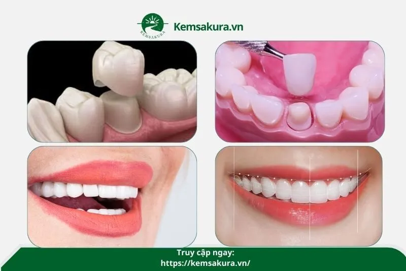 Top 10 địa chỉ bọc răng sứ Hậu Giang